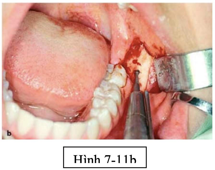 Phẫu thuật lấy mầm răng